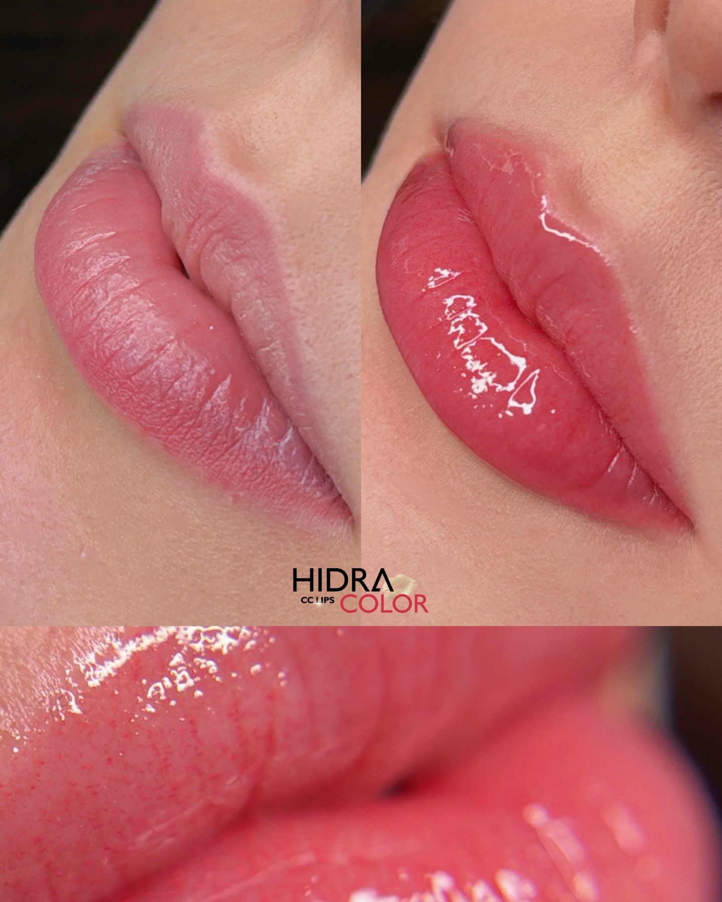 hidra1