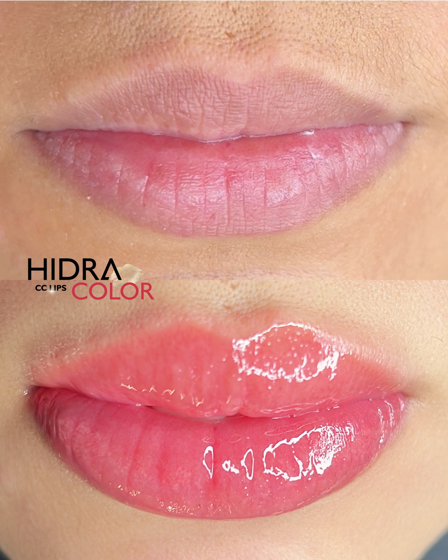 hidra2