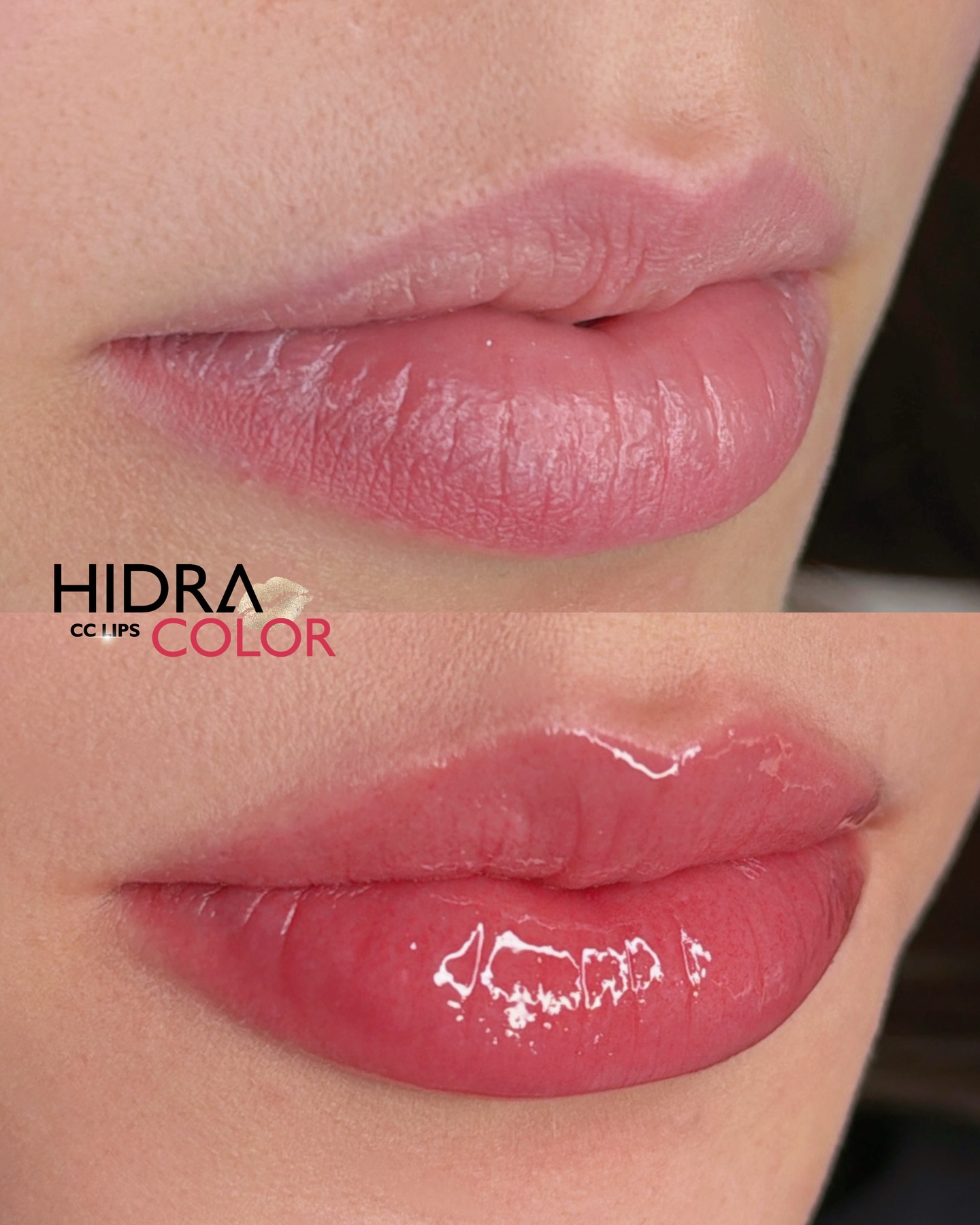 hidra3