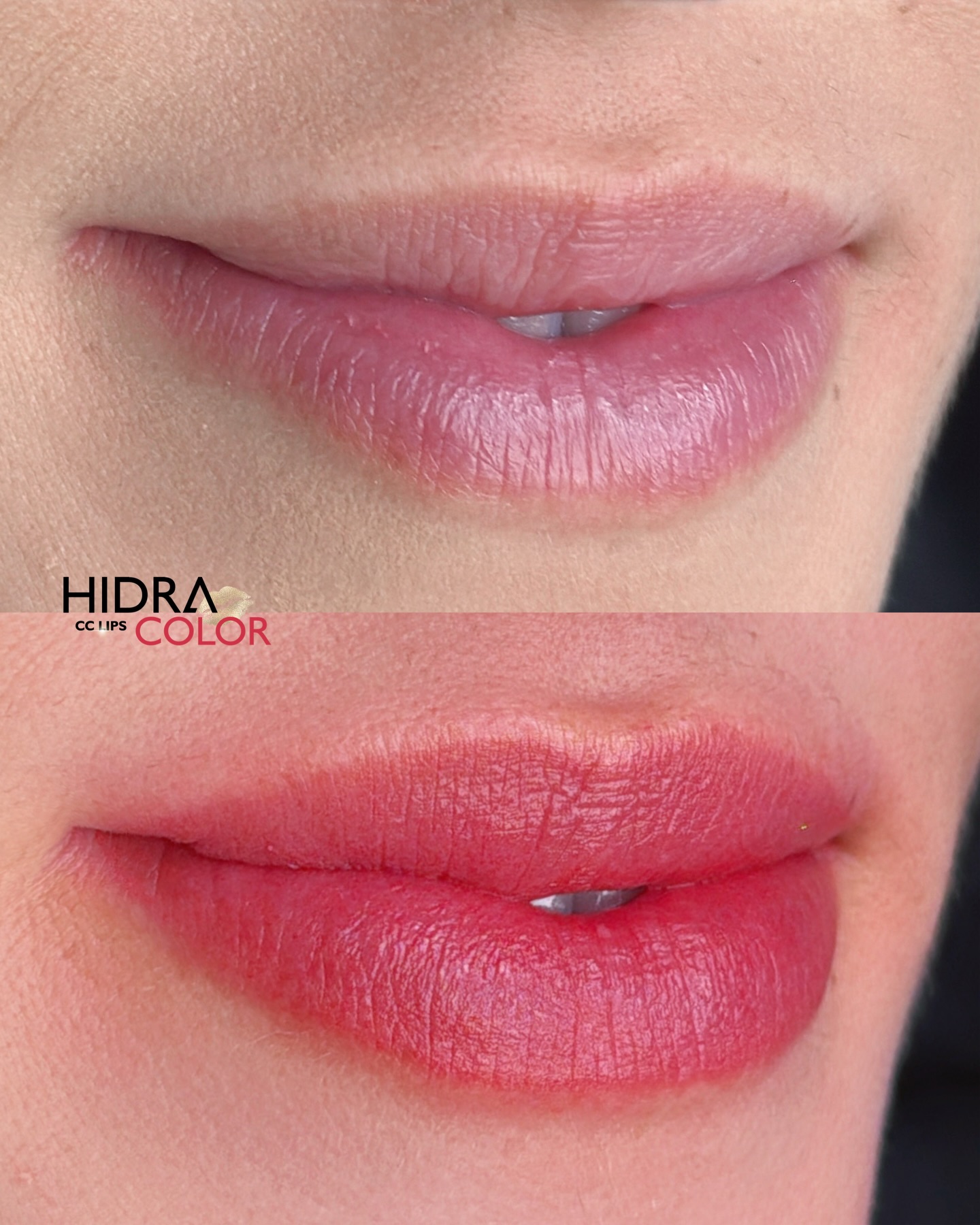 hidra4