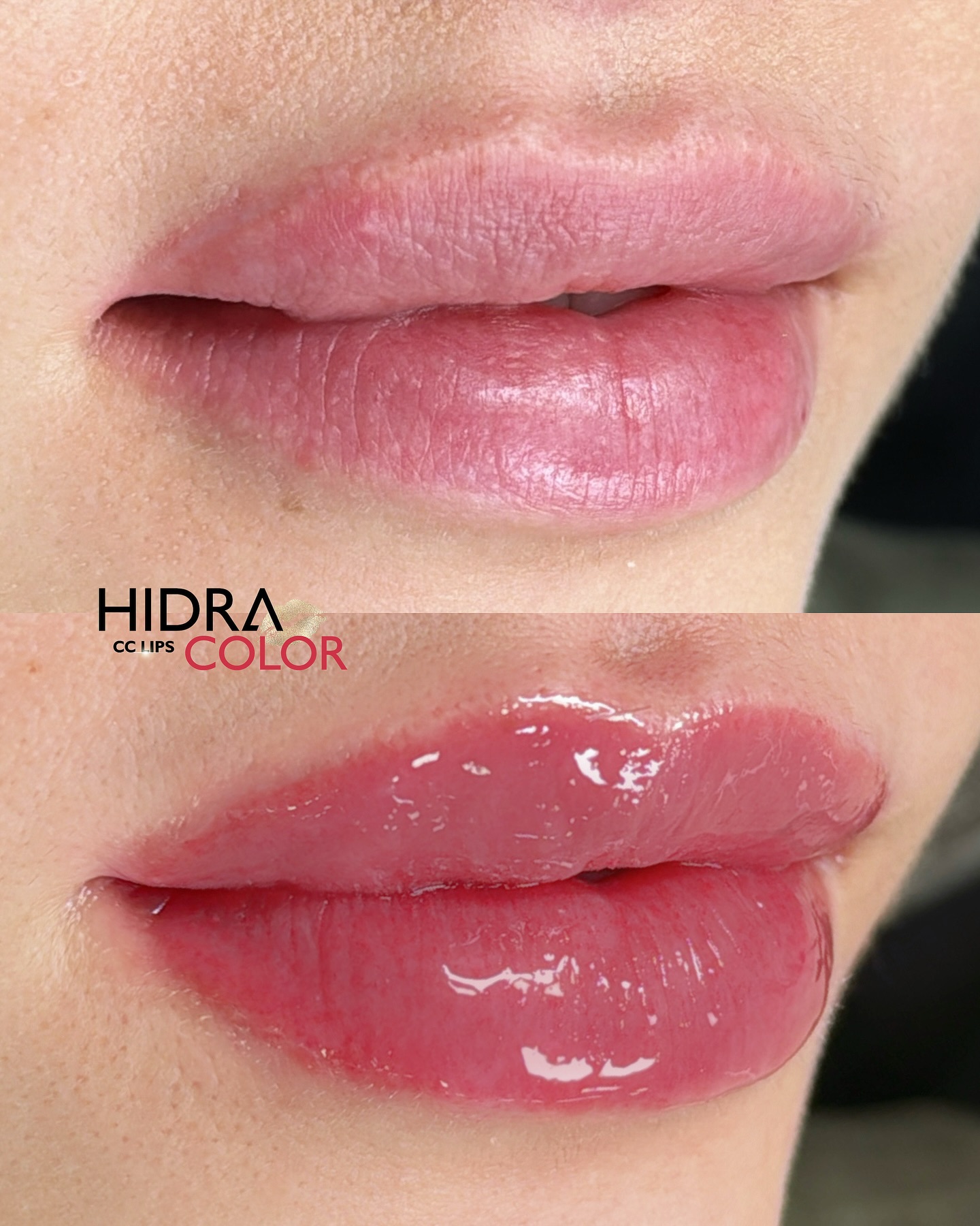 hidra5