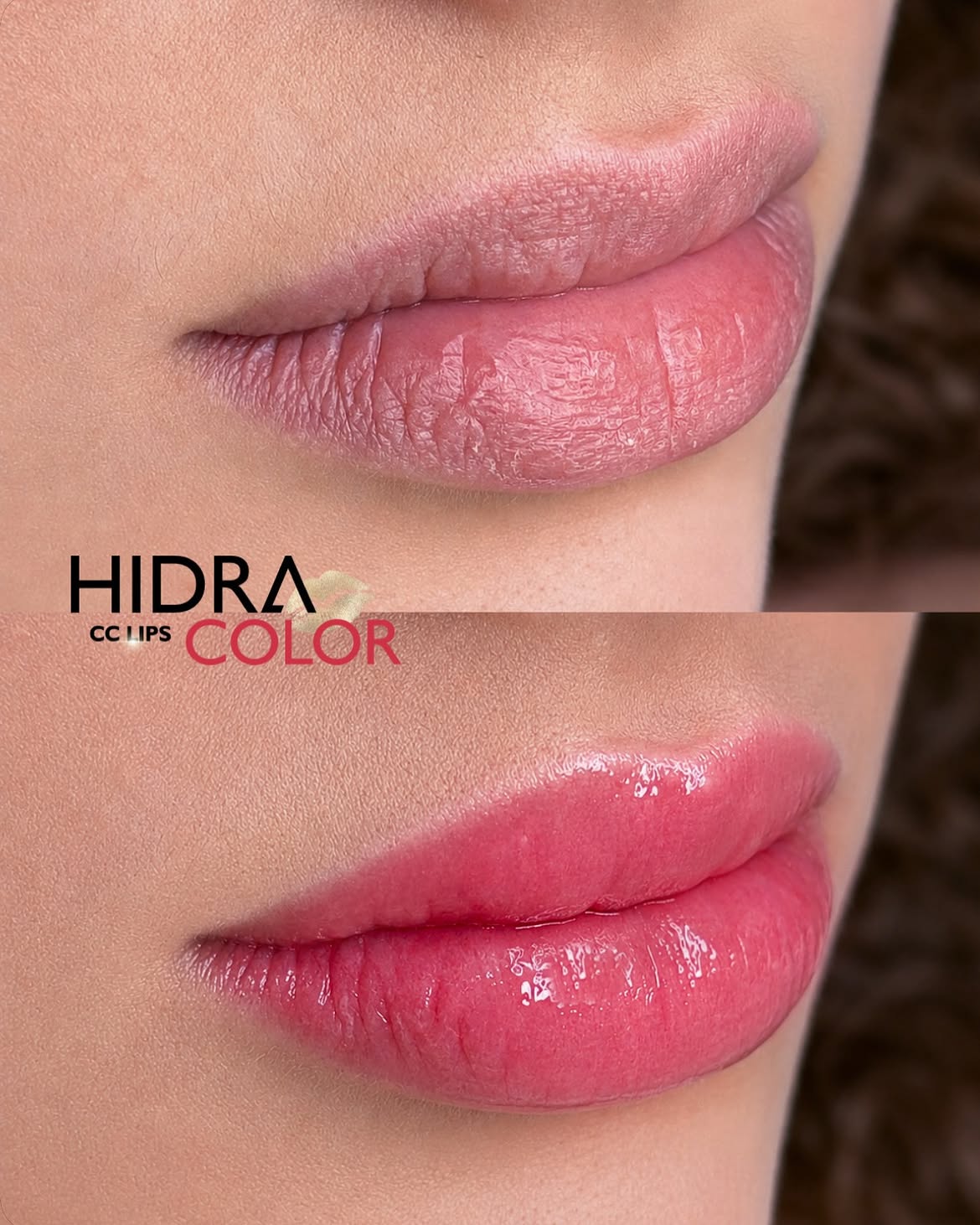 hidra6