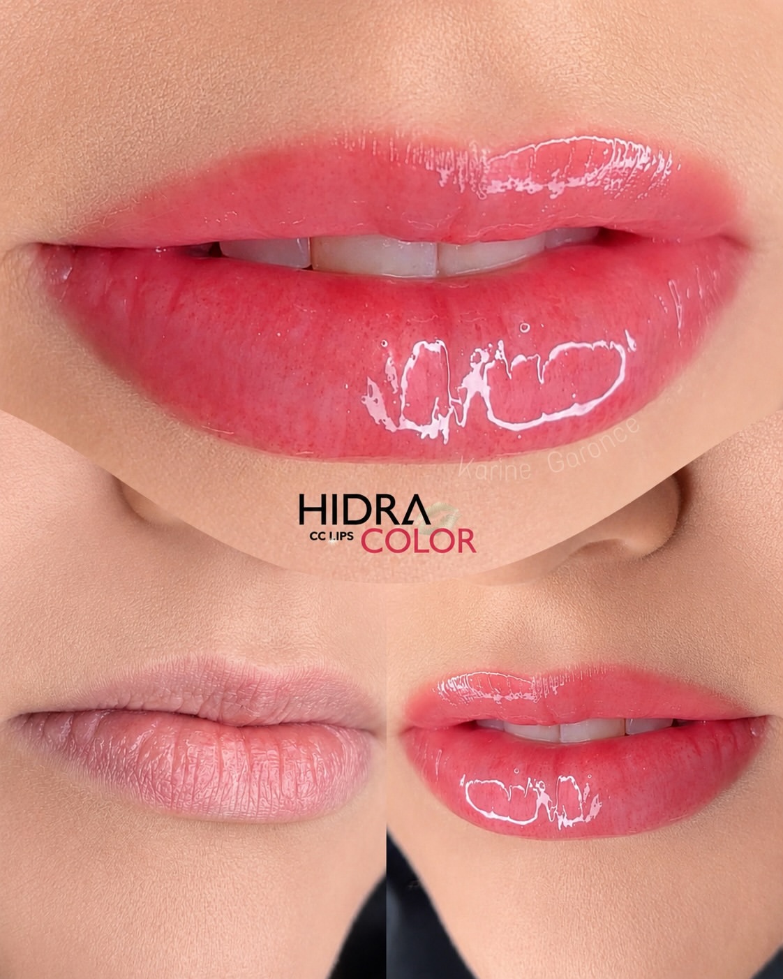 hidra7